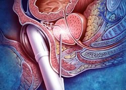 биопсия простаты - рисунок