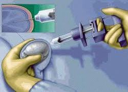 биопсия яичка - рисунок