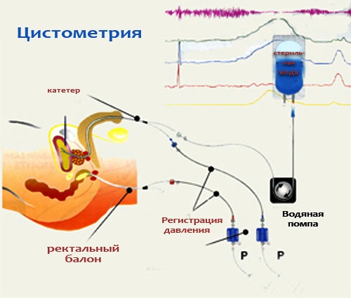 схема цистометрии