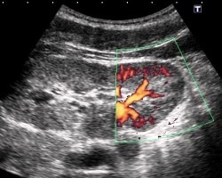 допплер почки - фото