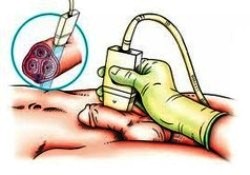 УЗИ члена - риунок