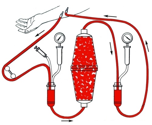 проведение гемосорбции - схема