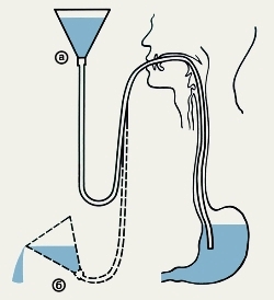 промывание желудка - картинка