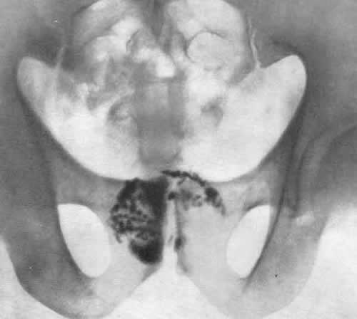 камни простаты