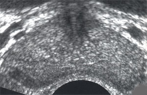 узи простаты