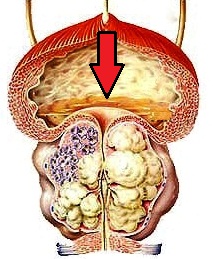 остаточная моча