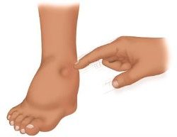 почечные отеки - рисунок