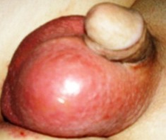 красная кожа мошонки - фото