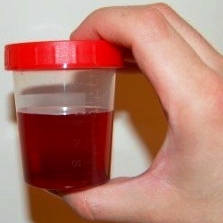 геморрагический цистит с кровью - фото