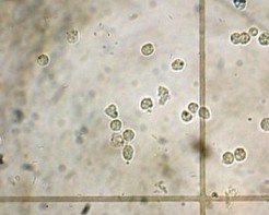 лейкоцитурия - лейкоциты в моче