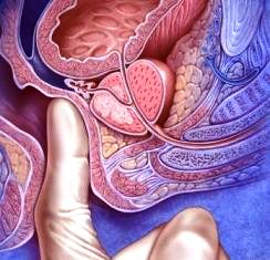 ректальное исследование простаты - фото