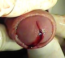 кровотечение из уретры