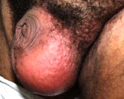 абсцесс мошонки - фото