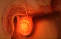 абсцесс яичка - фото