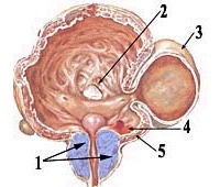 дивертикул мочевого пузыря - схема