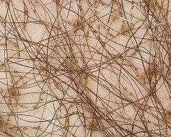 фтириаз - фотография