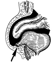 грыжа мочевого пузыря - рисунок