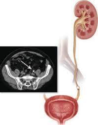 камень мочеточника - рисунок