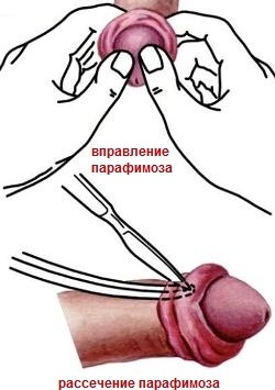 схема - лечение парафимоза
