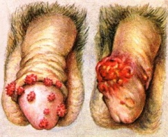 опухоль полового члена - фото