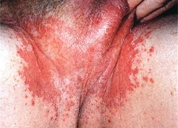 паховый микоз - фото - грибок промежности и мошонки