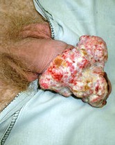 рак фаллоса - фото