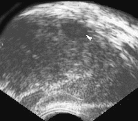 узи рак простаты