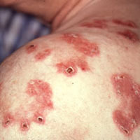 вторичный рецидивный сифилис - фото