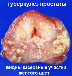 туберкулез простаты - фото