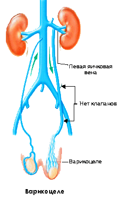 варикоцеле слева - рисунок