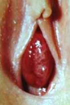 выпадение слизистой уретры - фото