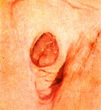 выпадение уретры - фото